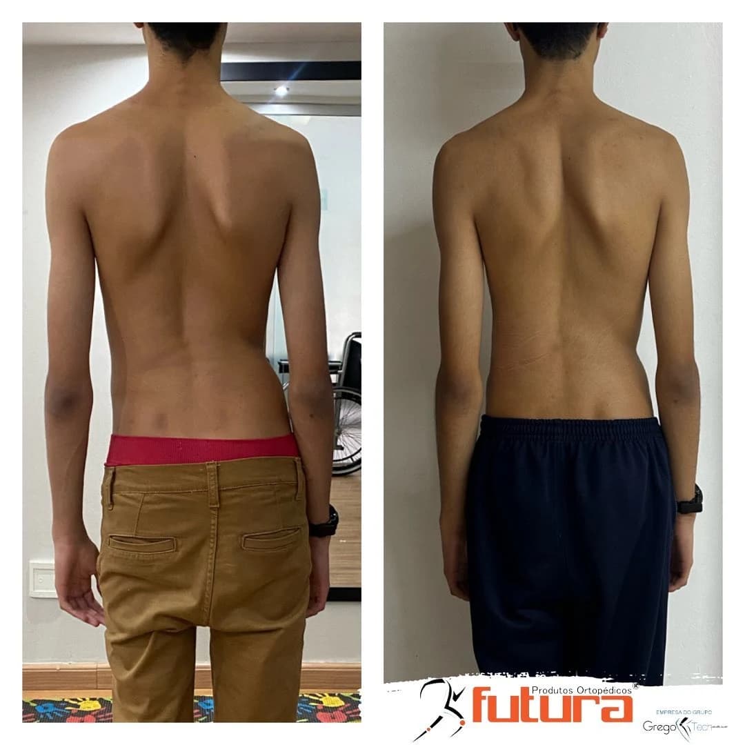 Comparação de duas fotos das costas de um paciente adolescente, de costas e sem camisa: à esquerda, antes do tratamento, com o tronco inclinado e assimetria entre os lados; à direita, depois do tratamento com colete, com a coluna mais alinhada e os ombros mais nivelados
